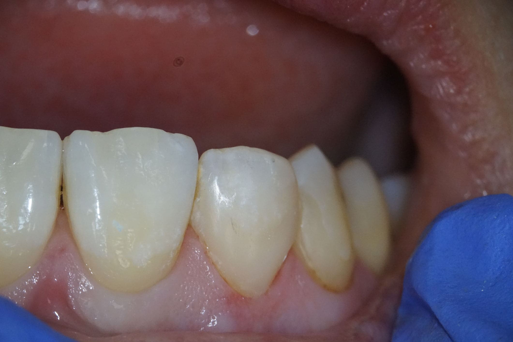 Sample after